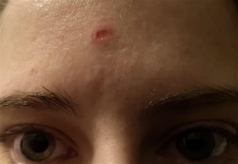 what causes holes in the face 2