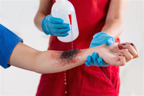 Chemical Burns: The Best Steps for Handling Them