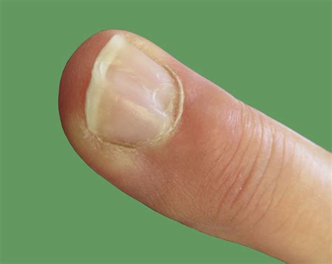 Mucous Cysts – Aberdeen Virtual Hand Clinic