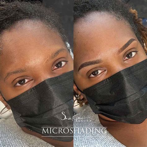 Scar Camouflage with Micropigmentation - Complete Guide