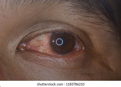 Fungal Eye Infections: Over 439 Royalty-Free Licensable Stock Photos ...