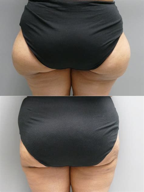 ultrasonic liposuction before and after - Pregnancy Depression