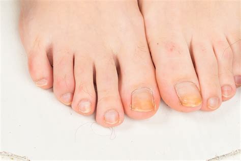 Why Nail Polish Turns Nails Yellow at Charles Macias blog