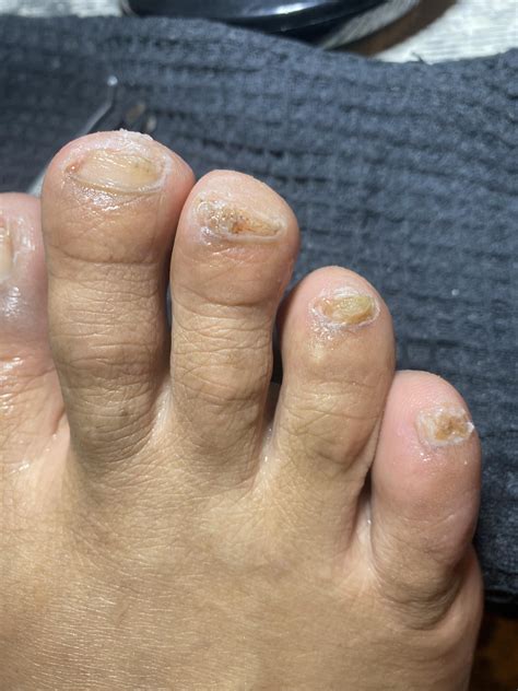 Does anyone know what kind of nail fungus this is and how to get rid of