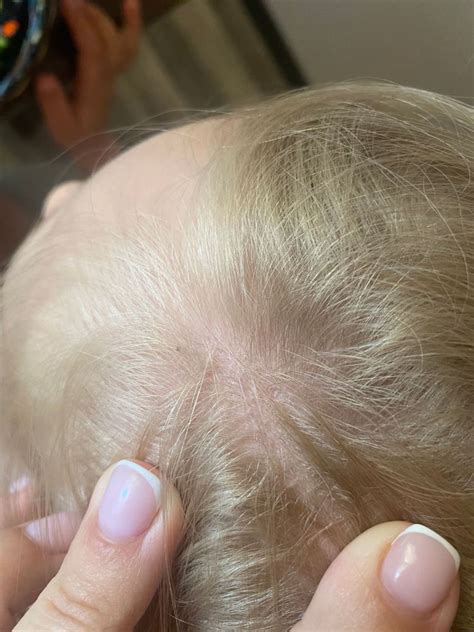 Чёрные точки в голове — 24 ответов | форум Babyblog