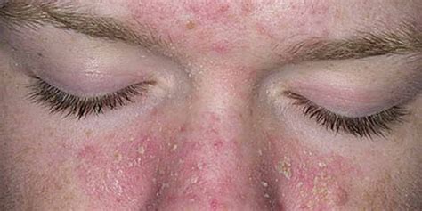 Dermatite Seborreica O Que É