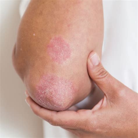 psoriasis psoriasisspeaks