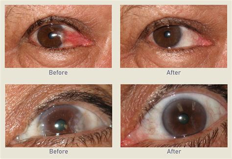 Pterygium Surgery – Aksha Eye Hospital Rajkot