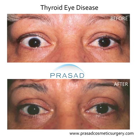 Thyroid Eye Disease Surgery/ Graves Eye Disease Surgery