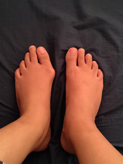 Bunionette : r/bunions