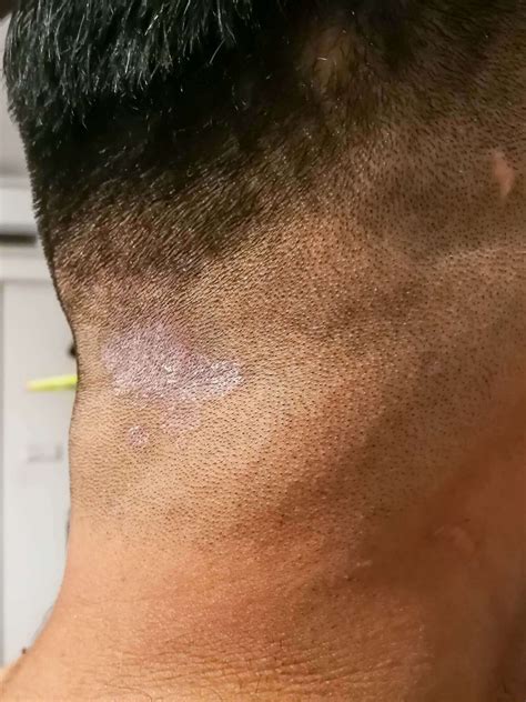 Tinea Capitis Ringworm Pictures Tinea Capitis Dermatology