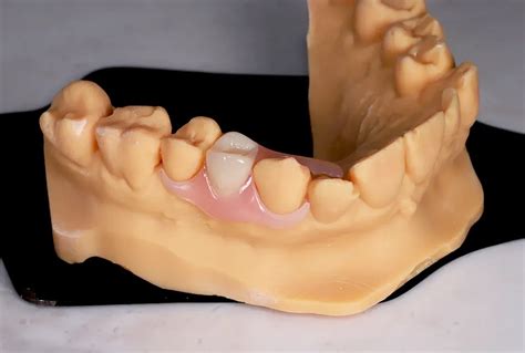 Flexible Partial Dentures - Simply Teeth