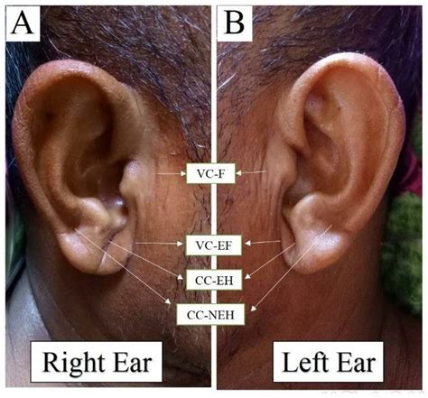 The bilateral DELC (Frank's sign): Four specific types of ear creases ...