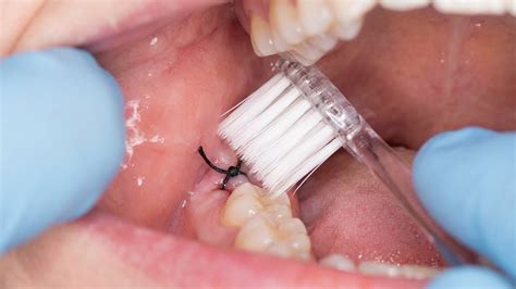 Pontos De Dente Cai Sozinho - Pontos da Extração de Siso: Quando Tirar? Dói? O que Fazer se Cair?