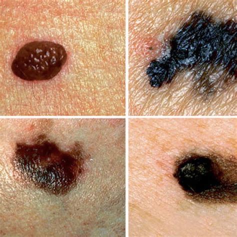About Melanoma - Melanoma Fund UK