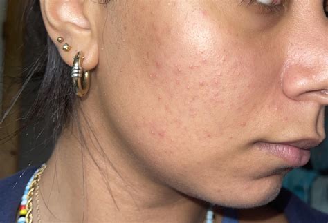 How do I repair my skin barrier?! I ruined my skin with salicylic acid