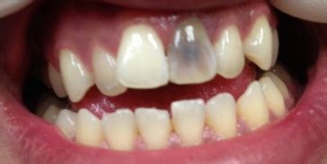 how to fix dead tooth