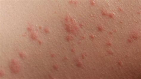 Skin Rashes