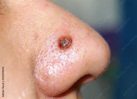 Inflamed pimple on nose. Cyst Acne. Acne on the skin Stock Photo ...