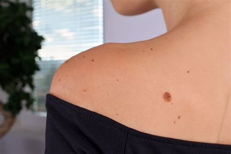 Types Of Moles On The Body
