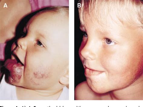 Figure 1 from Sclerotherapy for Treatment of Hemangiomas | Semantic Scholar
