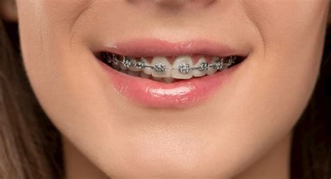 Cómo cepillar BIEN los dientes con BRACKETS | Cepillarse los Dientes