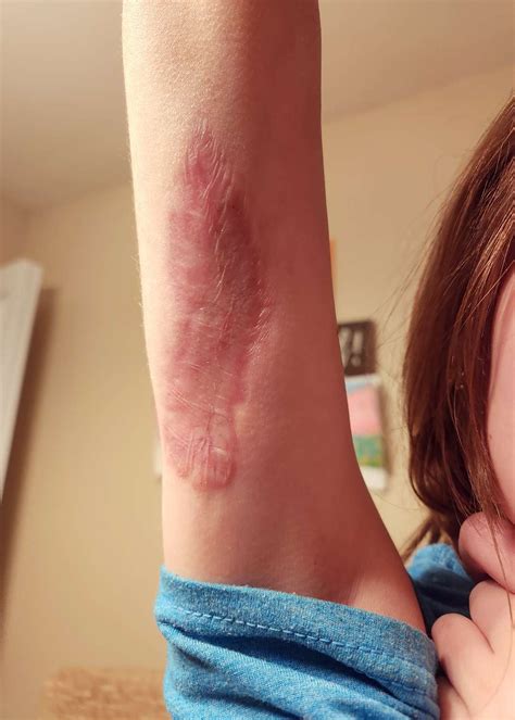 brown recluse bite pictures timeline
