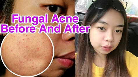 fungal acne    treatment youtube