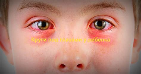 Круги под глазами у ребенка | Сайт о здоровье