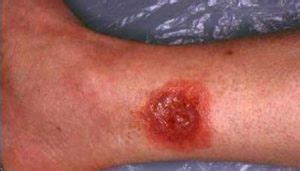 Wolf Spider Bite Pictures, Symptoms, What it Looks Like on Dog, Cat ...