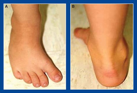metatarsus adductusskewfoot foot  ankle deformities principles