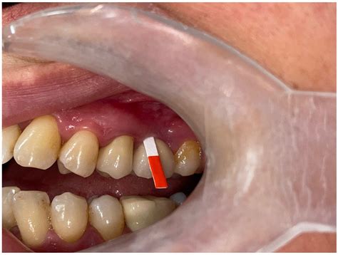 Association of Peri-Implant Keratinized Mucosa Width and Mucosal