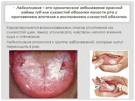 Лейкоплакия. Формы. Этиология. Лечение - презентация онлайн