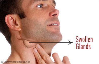 Casual Tips About How To Reduce Swollen Neck Glands - Motorstep
