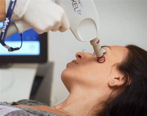 Pixel Laser Resurfacing – shimaabeautycenter.com