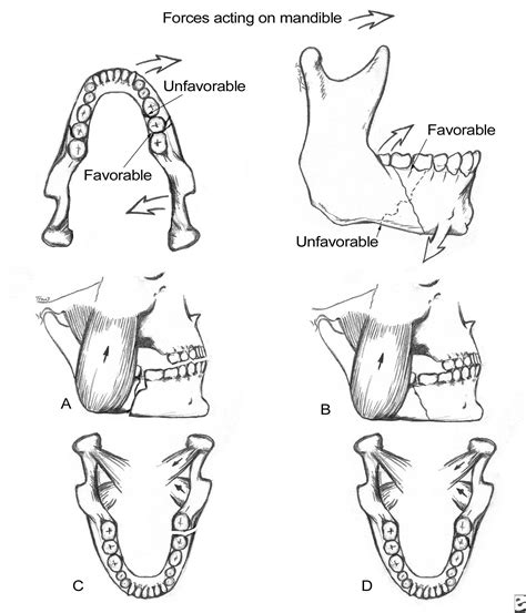 ORAL & MAXILLO-FACIAL SURGERY: Mandibular Angle Fractures