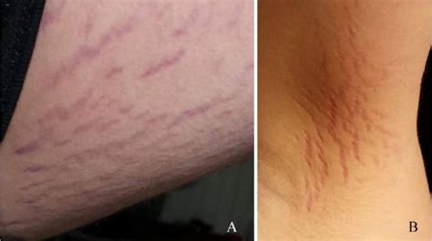 Cat scratch disease caused teen's schizophrenia-like symptoms, report