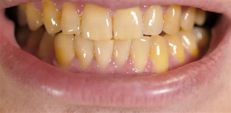 What Causes Yellow Teeth? - Dr. Miski