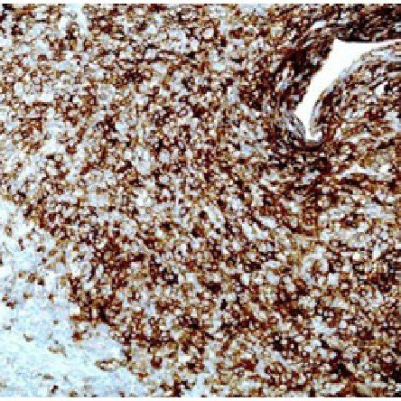 Figure No 2: Histological appearance showing expression of CD20 in ...