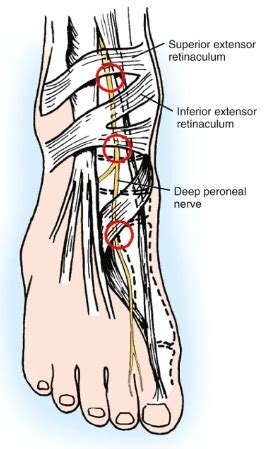 Deep Peroneal Nerve Entrapment - Foot & Ankle - Orthobullets