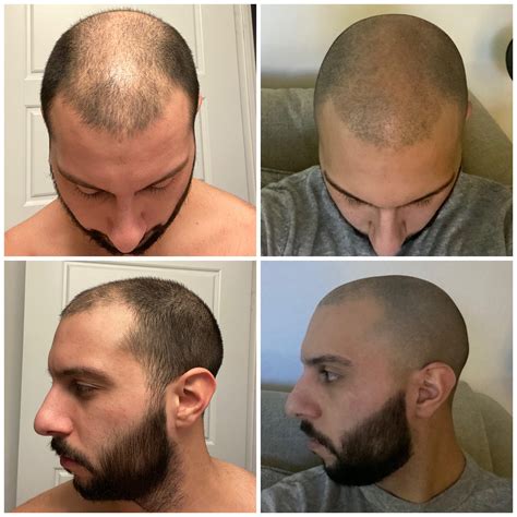 Decided to just accept my baldness and buzz my hair down as short as it