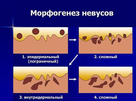 Невусы и меланомы. Морфогенез невусов - презентация онлайн