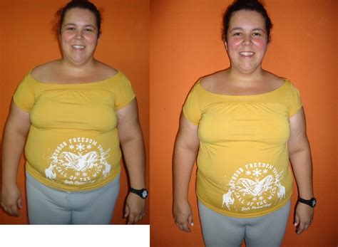 Antes E Depois Bariatrica - Diário da minha cirurgia bariátrica: Fotos antes e depois - 30 dias