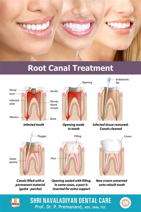 root canal treatment shri navaladiyan dental care