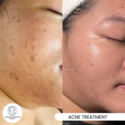 BEFORE AND AFTER: ACNE TREATMENT PROCESS – Lì Medical Spa