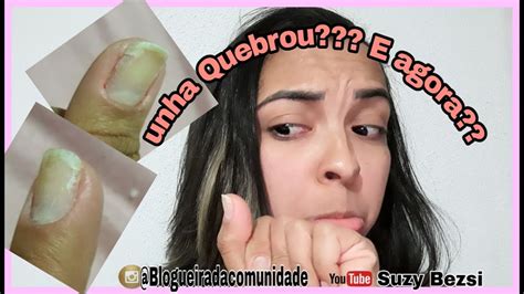 Unha Quebrou Na Carne Sangrando - Unha quebrou na carne??? SUZY O QUE EU FAÇO????? - YouTube