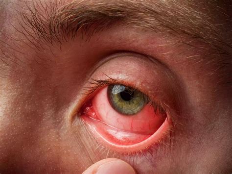 What Does Pink Eye Look Like? | Dr Farrah MD