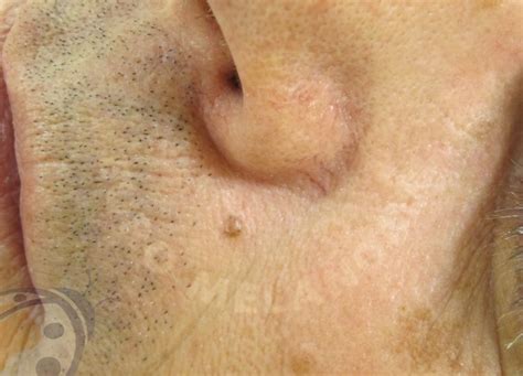 Basaliom - Euromelanoma
