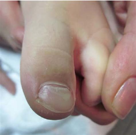 Figure 3 from ONYCHOMADESIS FOLLOWING HAND-FOOT-MOUTH DISEASE ...