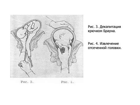 Поперечное и косое положения плода. Запущенное поперечное положение ...